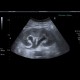 Hydronephrosis: US - Ultrasound